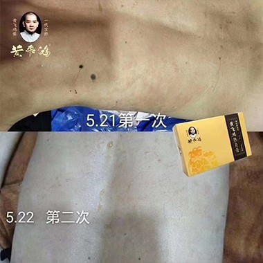 热灸膏使用案例