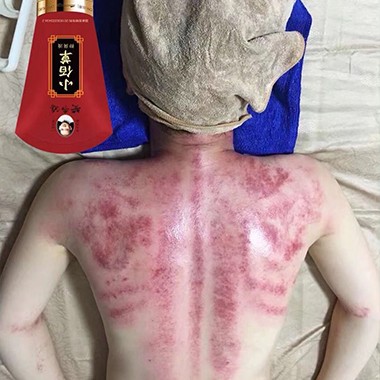 黄飞鸿小佰草抑菌液案例
