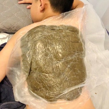 黄飞鸿热灸膏使用案例 