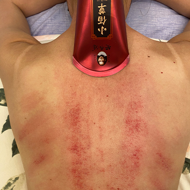 黄飞鸿小佰草抑菌液刮痧案例